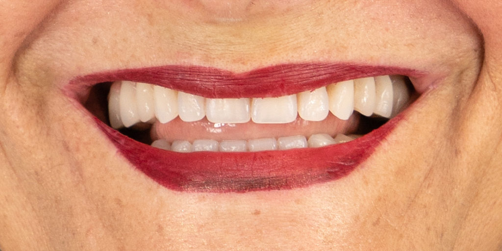 Denti fissi in 24 ore: è davvero possibile riavere una dentatura fissa in pochissimo tempo su pazienti clinicamente idonei?
