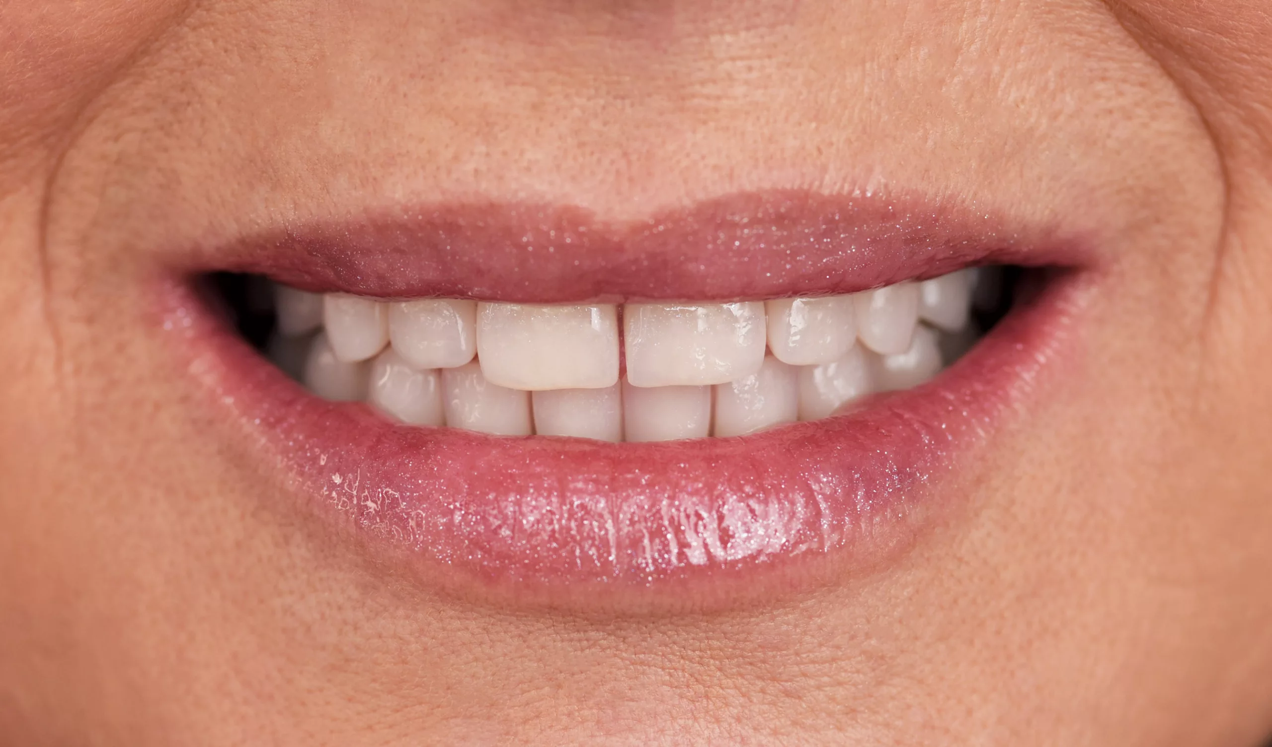 Impianti dentali: la giusta soluzione per riavere un nuovo sorriso?